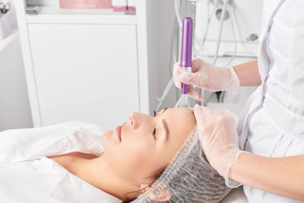 How Many Microneedling Sessions for Acne Scars: A Comprehensive Treatment